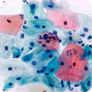 Rankin EA-36 Papanicolaou stain consumables in a gallon bottle, used for cytology and Pap smear preparations.