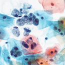 Rankin OG-6 Papanicolaou stain consumables in a gallon bottle, used for cytology slide staining and diagnostic laboratory work.
